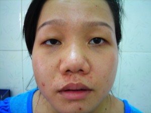 Thực hiện chỉnh hình sụp mí bẩm sinh có đau không?