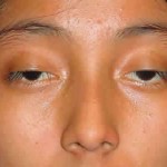 Chỉnh hình sụp mí bẩm sinh và những lưu ý chăm sóc sau phẫu thuật