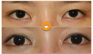 Tạo khóe mắt công nghệ Hàn Quốc được thực hiện như thế nào?