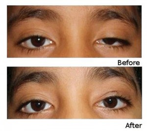 Thời gian thực hiện chỉnh hình sụp mí bẩm sinh có lâu không?