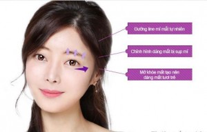 Tiến hành tạo khóe mắt CN Hàn Quốc có gây đau đớn gì không?