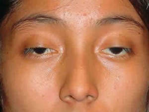 Về bệnh sụp mí bẩm sinh và giải pháp chữa trị tốt nhất hiện nay