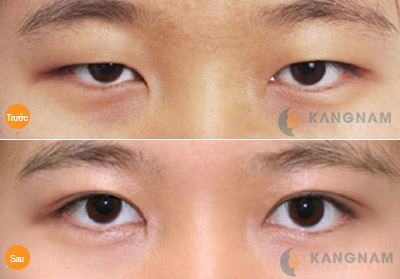 Bấm mí mắt vĩnh viễn Dove Eyes Hàn Quốc tạo mắt bồ câu đẹp hoàn hảo56677