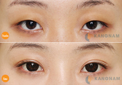 Bấm mí mắt vĩnh viễn Dove Eyes Hàn Quốc tạo mắt bồ câu đẹp hoàn hảo56567773