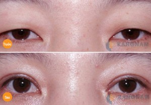 Những ai nên thực hiện bấm mí mắt Hàn Quốc Dove Eyes?