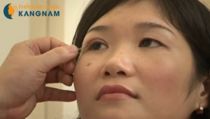 Nên đi bấm mí mắt bằng phương pháp nào?