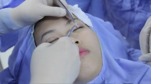Mắt đã từng mổ cận có bấm mí Hàn Quốc được không?