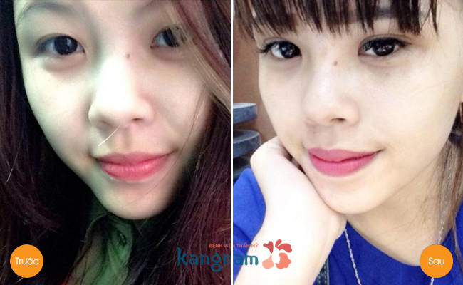 bấm mí Hàn Quốc giá bao nhiêu tiền?7