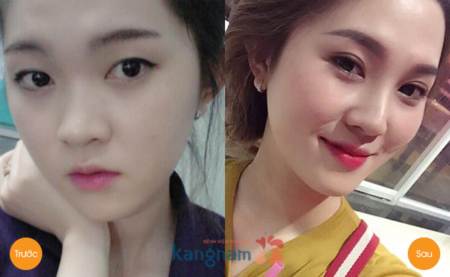 bấm mí Hàn Quốc giá bao nhiêu tiền?6