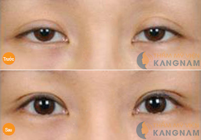 Địa chỉ thẩm mỹ mắt uy tín chuẩn Hàn ngay tại Việt Nam9000