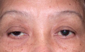 Học cách xoa bóp, bấm huyệt chữa sụp mí bẩm sinh