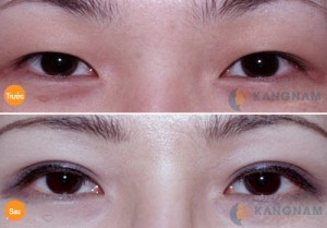 Xin hỏi bấm mí Hàn Quốc có an toàn không?