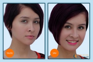 Phẫu thuật treo mí mắt giá bao nhiêu?