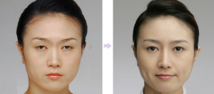 Cùng chuyên gia phân tích về phẫu thuật mí mắt bị sụp bẩm sinh