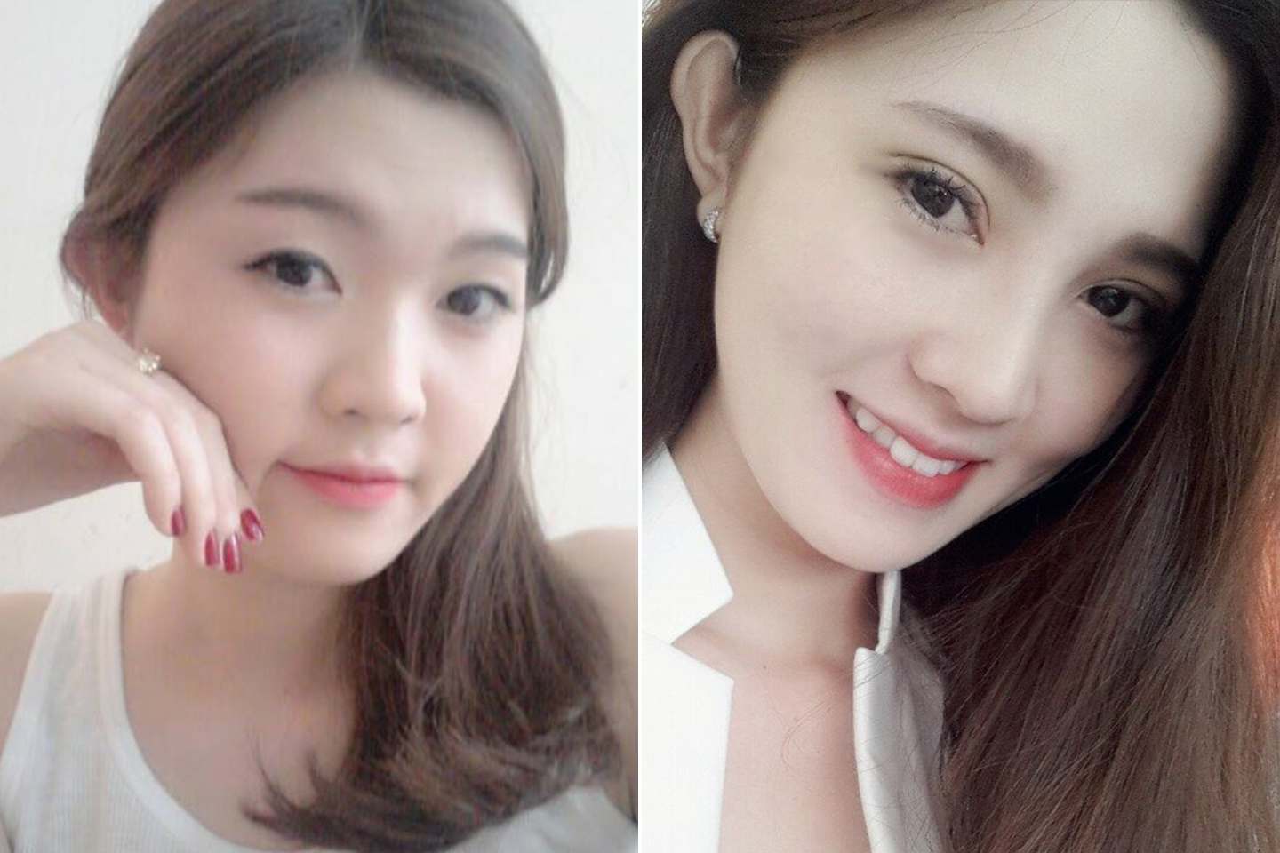 Mắt 2 mí to tròn đã không còn là giấc mơ với Tô Tuyết Trâm 11 Mắt 2 mí to tròn đã không còn là giấc mơ với Tô Tuyết Trâm 10