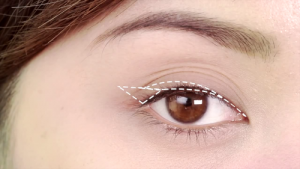 Làm sao chỉnh sửa mắt nhiều mí hiệu quả?