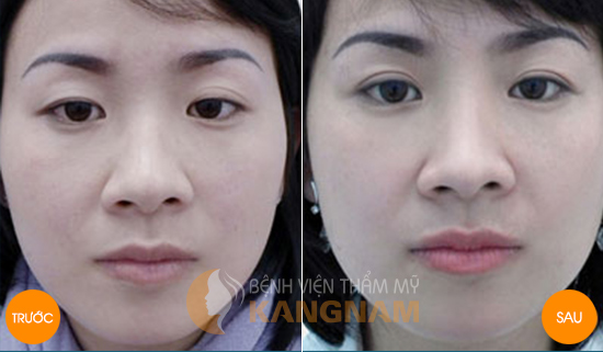 Top 4 cách nâng mí mắt bị sụp nhanh và hiệu quả nhất4567