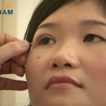 Khác biệt giữa cắt và bấm mí mắt là gì? Nên bấm hay cắt mí?