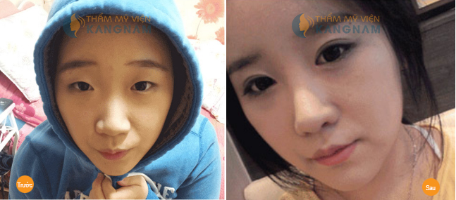 Địa chỉ thẩm mỹ mắt uy tín chuẩn Hàn ngay tại Việt Nam90000