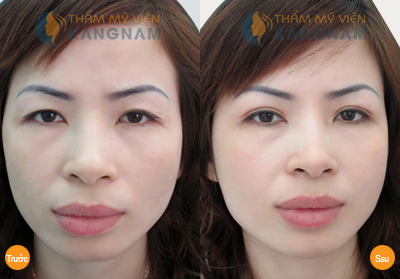 Địa chỉ thẩm mỹ mắt uy tín chuẩn Hàn ngay tại Việt Nam9000--