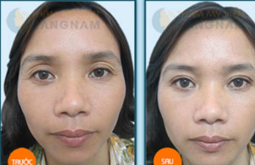 OFF 30% - Tạo mắt 2 mí hoàn hảo - Đẹp trọn đời88