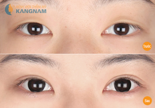 Kẹp tạo mắt 2 mí có đem lại hiệu quả như ý không? 12 Kẹp tạo mắt 2 mí có đem lại hiệu quả như ý không? 11