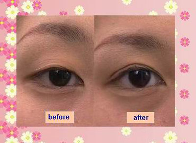 Kẹp tạo mắt 2 mí có đem lại hiệu quả như ý không? 4 Kẹp tạo mắt 2 mí có đem lại hiệu quả như ý không? 3