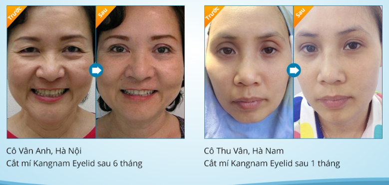 Phẫu thuật cắt mí mắt bao nhiêu tiền?7