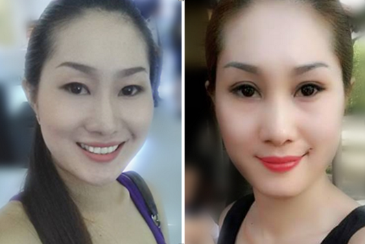 Phẫu thuật cắt mí mắt bao nhiêu tiền?8