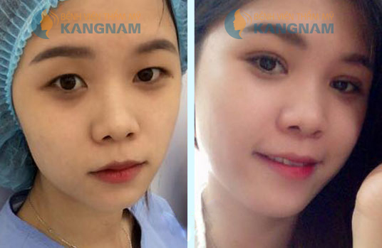 mắt đẹp 2 mí 778