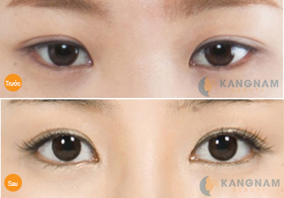 Khắc phục mắt xếch toàn diện chỉ sau 40 phút3678