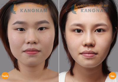 Khắc phục mắt xếch toàn diện chỉ sau 40 phút900--