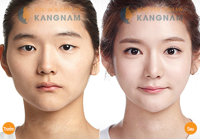 Khắc phục mắt xếch toàn diện chỉ sau 40 phút579