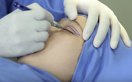 Bấm mí khác cắt mí6