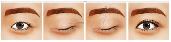 Bấm mí khác cắt mí4