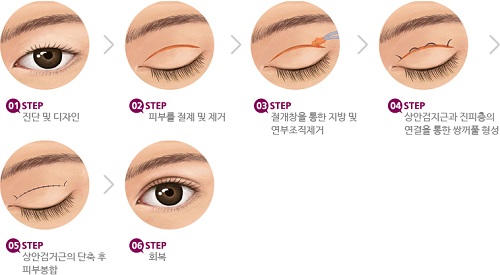 Bấm mí khác cắt mí5