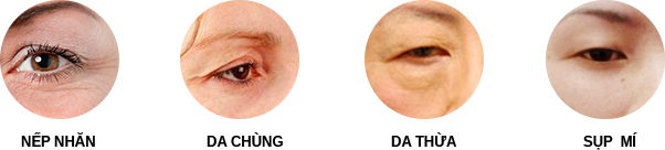 Bấm mí khác cắt mí3