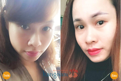 Bấm mí khác cắt mí145