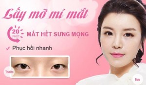 Lấy mỡ mí mắt Hàn Quốc trẻ hóa đôi mắt – Tạo mắt đẹp toàn diện