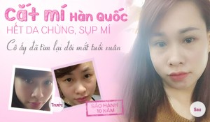 Phẫu thuật cắt mí mắt dưới – Cho đôi mắt trẻ hơn 10 tuổi