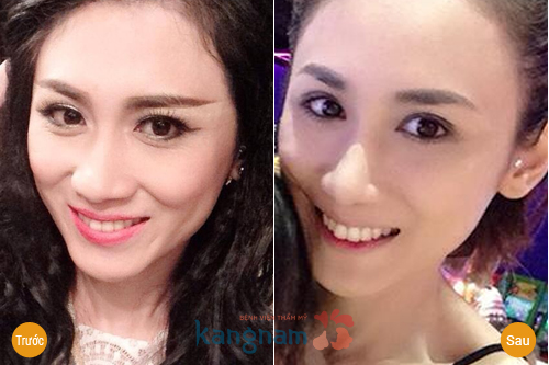 Bấm mí khác cắt mí19