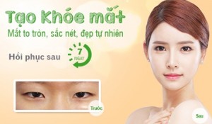 Tạo (cắt) khóe mắt công nghệ Hàn Quốc