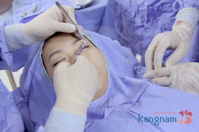 Tạo (cắt) khóe mắt 4567