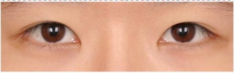 Tạo (cắt) khóe mắt 2