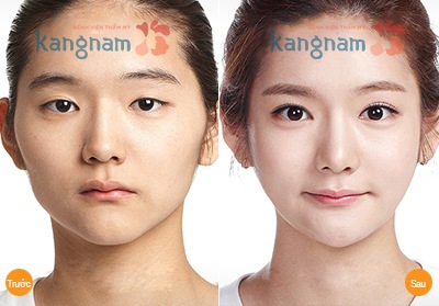 Tạo (cắt) khóe mắt 3