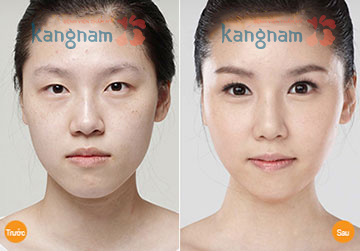 Tạo (cắt) khóe mắt 5