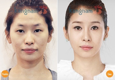 Tạo (cắt) khóe mắt7 7