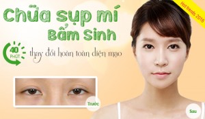 Phẫu thuật chữa sụp mí mắt bẩm sinh tạo mắt đẹp trẻ trung