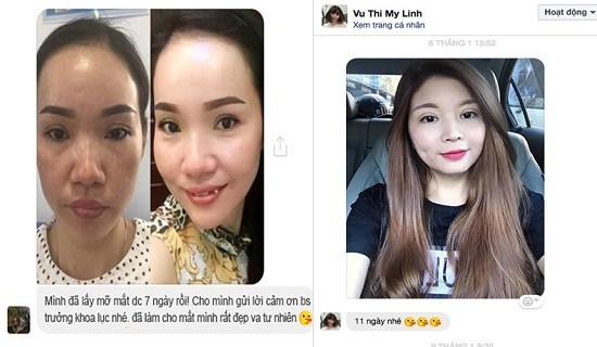 Khác biệt giữa trước sau lấy mỡ mí mắt trên tại Kangnam