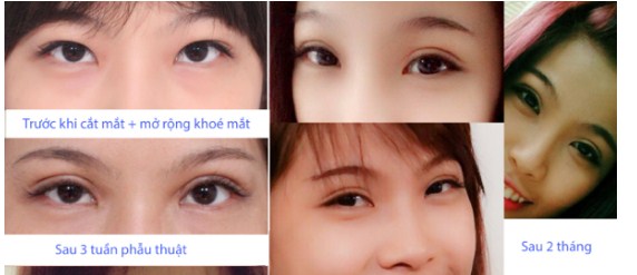 Tạo khóe mắt trong là gì? Tại sao phải tạo khóe mắt trong?